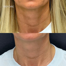 Load image into Gallery viewer, Fotona® Neck Neglect Package (X6)
